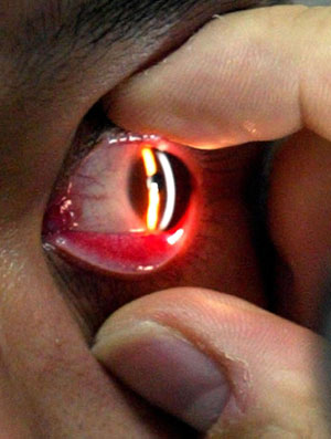 急性出血性結膜炎