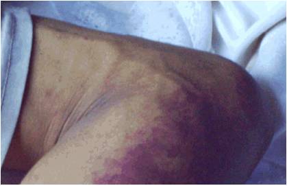 人豬重癥鏈球菌感染